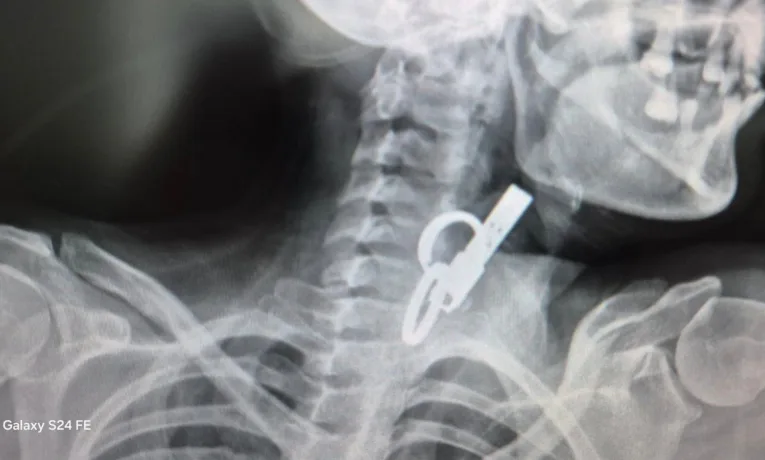 На Тернопільщині жінка тиждень ходила з дверним ключем у стравоході