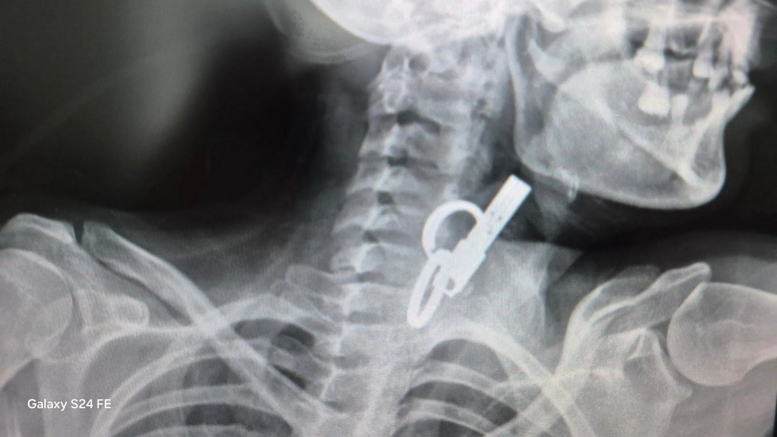 На Тернопільщині жінка тиждень ходила з дверним ключем у стравоході